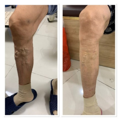 Máy nén ép trị liệu suy giãn tĩnh mạch chân Kachi MK394 - Hàng chính hãng