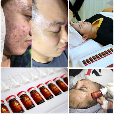 Tế bào Gốc hỗ trợ trị mụn acne Ampoule Larian ( Combo 3 lọ )