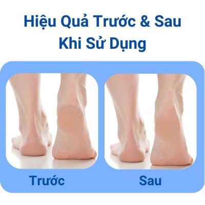 Dụng Cụ Chà Gót Chân Có Tay Cầm - Tẩy Tế Bào Chết, Giúp Da Chân Mềm Mại, Sạch Sẽ - HÀNG CHÍNH HÃNG MINIIN